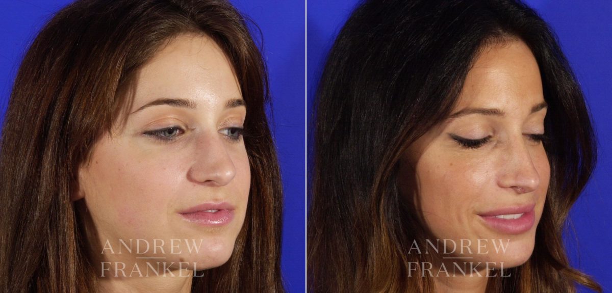 Rhinoplasty before and after photos in Beverly Hills, CA, Patient 6149