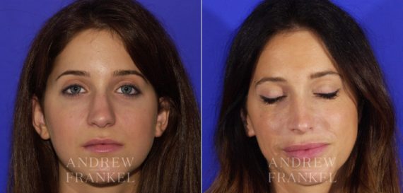 Rhinoplasty before and after photos in Beverly Hills, CA, Patient 6149