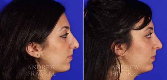Rhinoplasty before and after photos in Beverly Hills, CA, Patient 6167