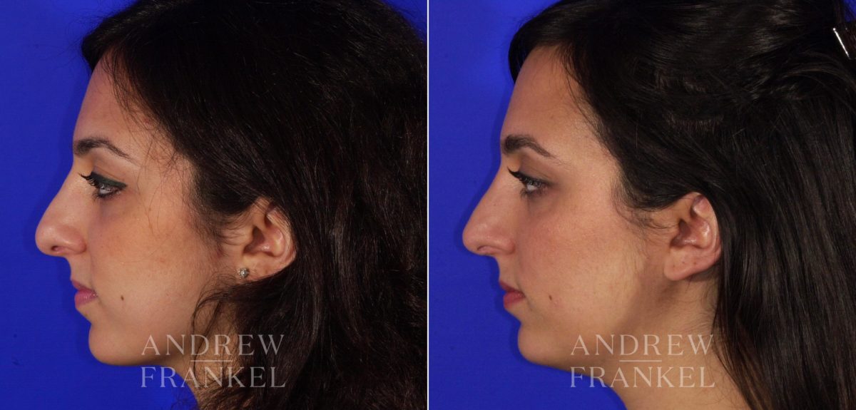Rhinoplasty before and after photos in Beverly Hills, CA, Patient 6167