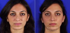 Rhinoplasty before and after photos in Beverly Hills, CA, Patient 6167