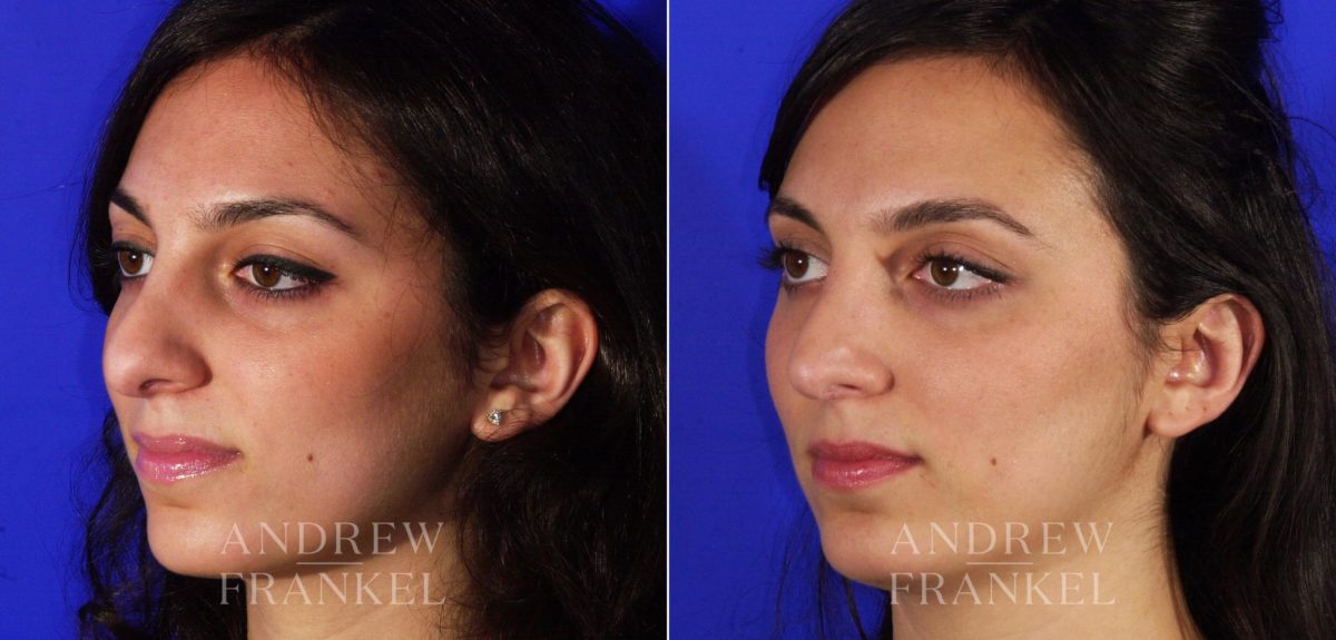 Rhinoplasty before and after photos in Beverly Hills, CA, Patient 6167