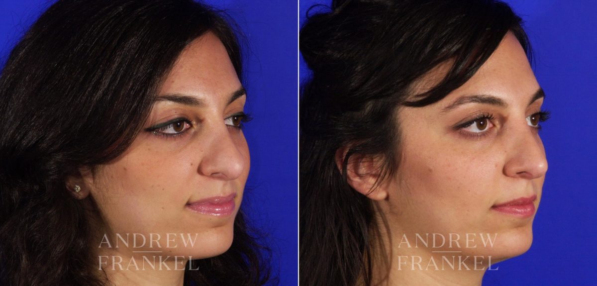 Rhinoplasty before and after photos in Beverly Hills, CA, Patient 6167