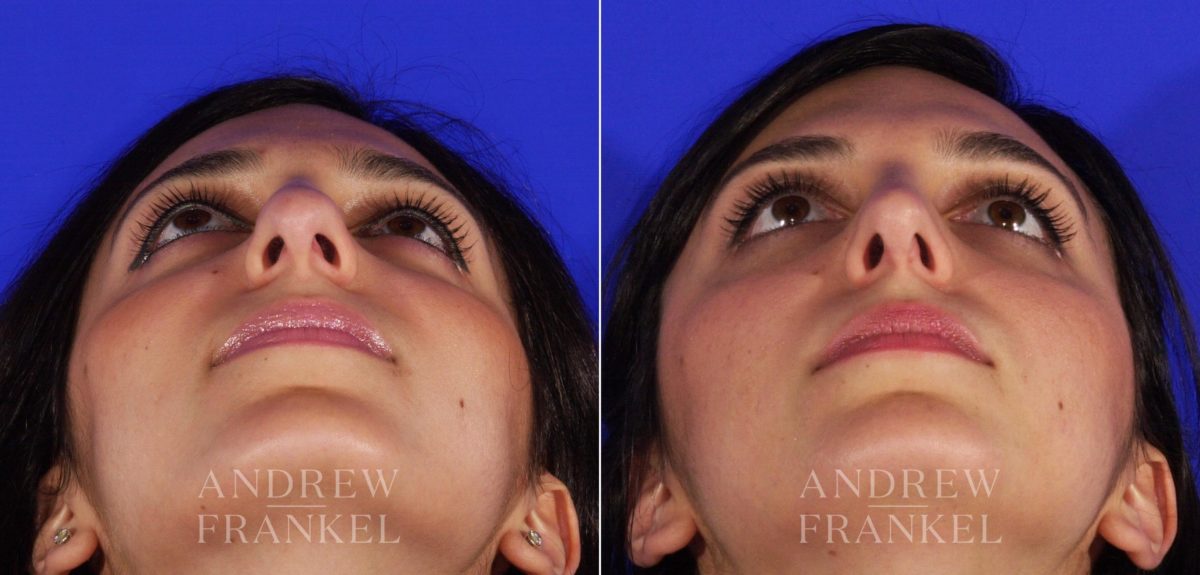 Rhinoplasty before and after photos in Beverly Hills, CA, Patient 6167