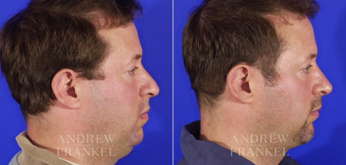 Rhinoplasty before and after photos in Beverly Hills, CA, Patient 6220