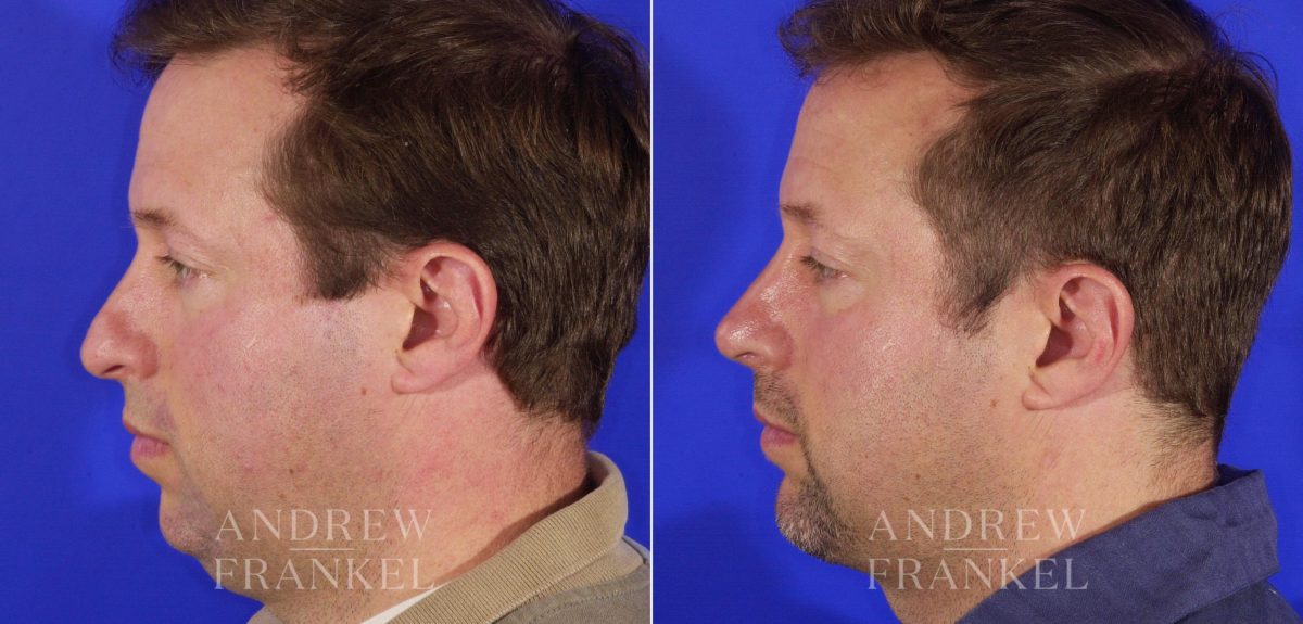 Rhinoplasty before and after photos in Beverly Hills, CA, Patient 6220