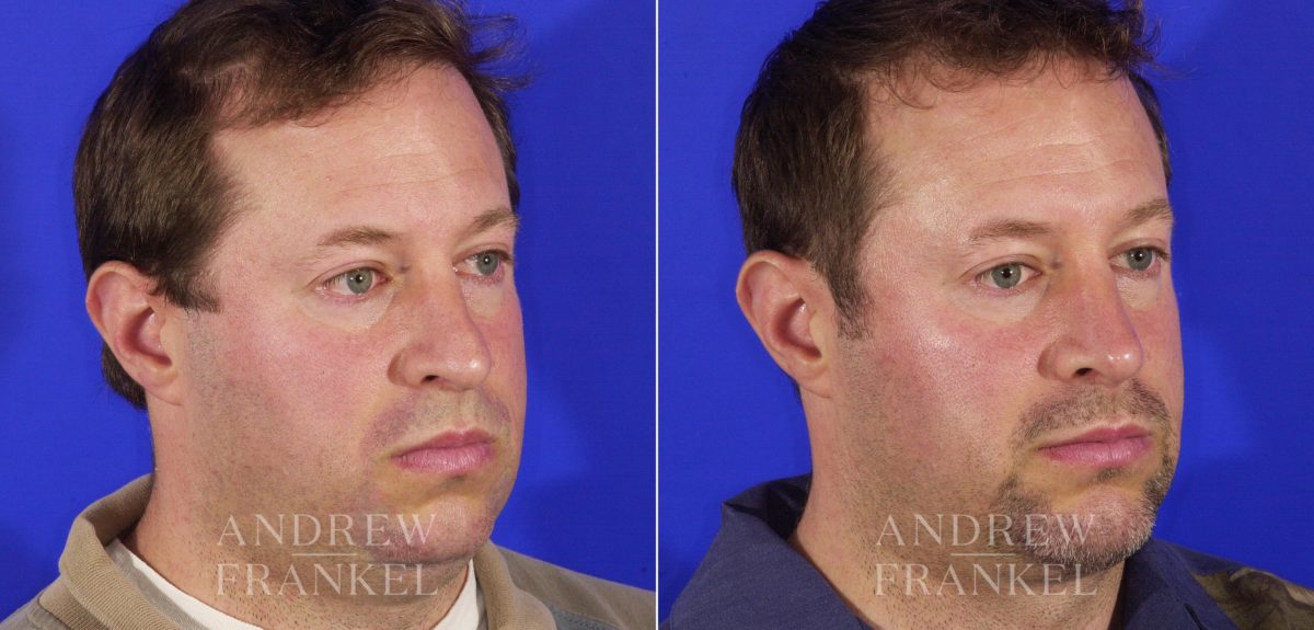 Rhinoplasty before and after photos in Beverly Hills, CA, Patient 6220