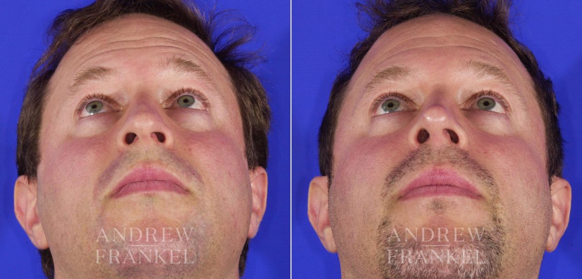 Rhinoplasty before and after photos in Beverly Hills, CA, Patient 6220