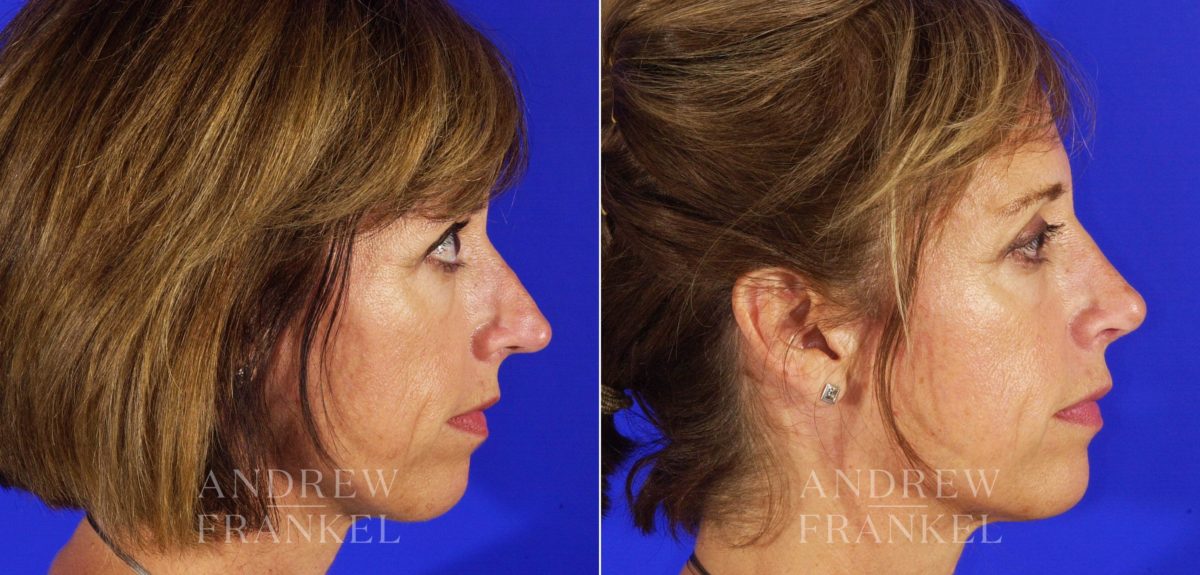 Rhinoplasty before and after photos in Beverly Hills, CA, Patient 6359