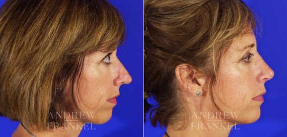 Rhinoplasty before and after photos in Beverly Hills, CA, Patient 6359