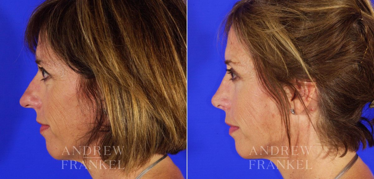 Rhinoplasty before and after photos in Beverly Hills, CA, Patient 6359