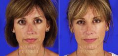 Rhinoplasty before and after photos in Beverly Hills, CA, Patient 6359