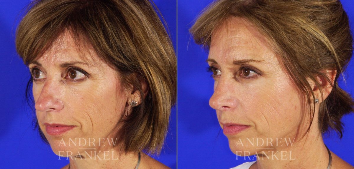 Rhinoplasty before and after photos in Beverly Hills, CA, Patient 6359