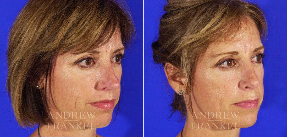 Rhinoplasty before and after photos in Beverly Hills, CA, Patient 6359