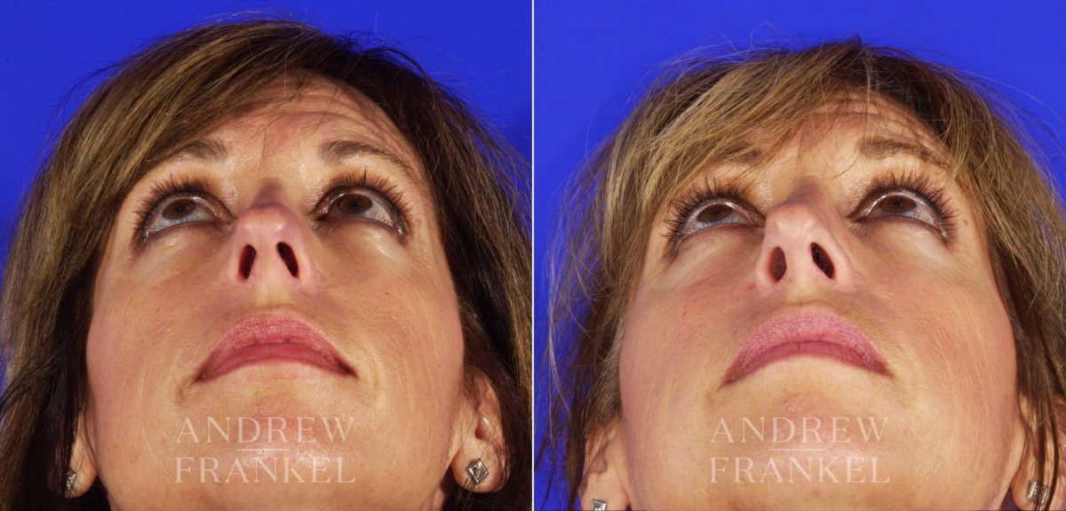 Rhinoplasty before and after photos in Beverly Hills, CA, Patient 6359