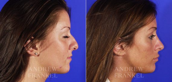 Rhinoplasty before and after photos in Beverly Hills, CA, Patient 6385
