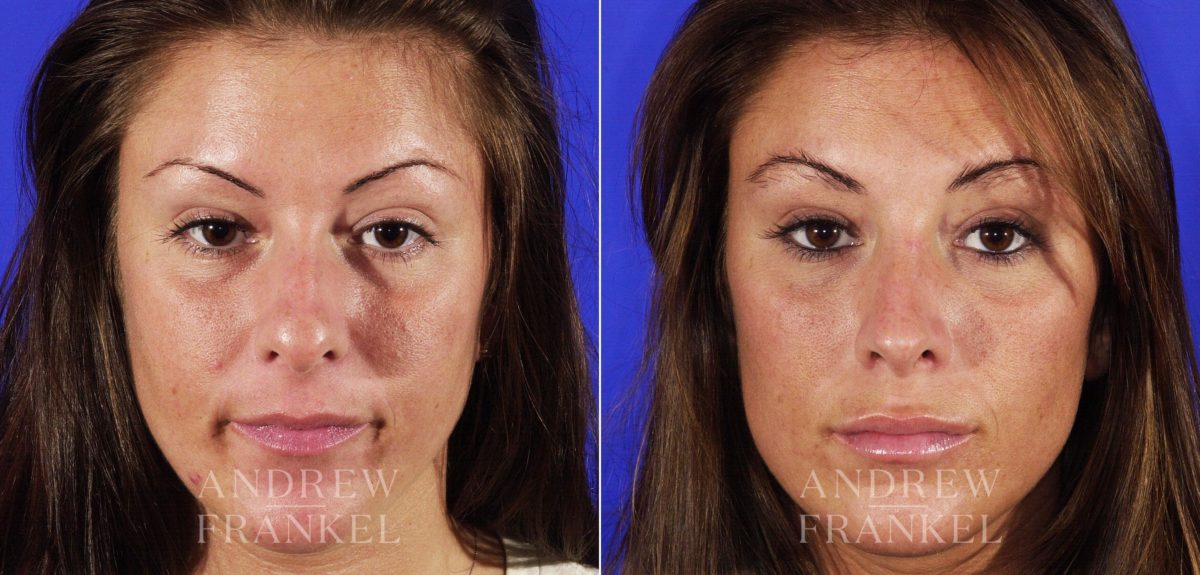 Rhinoplasty before and after photos in Beverly Hills, CA, Patient 6385