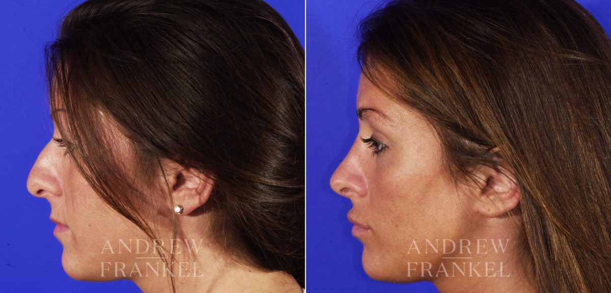 Rhinoplasty before and after photos in Beverly Hills, CA, Patient 6385