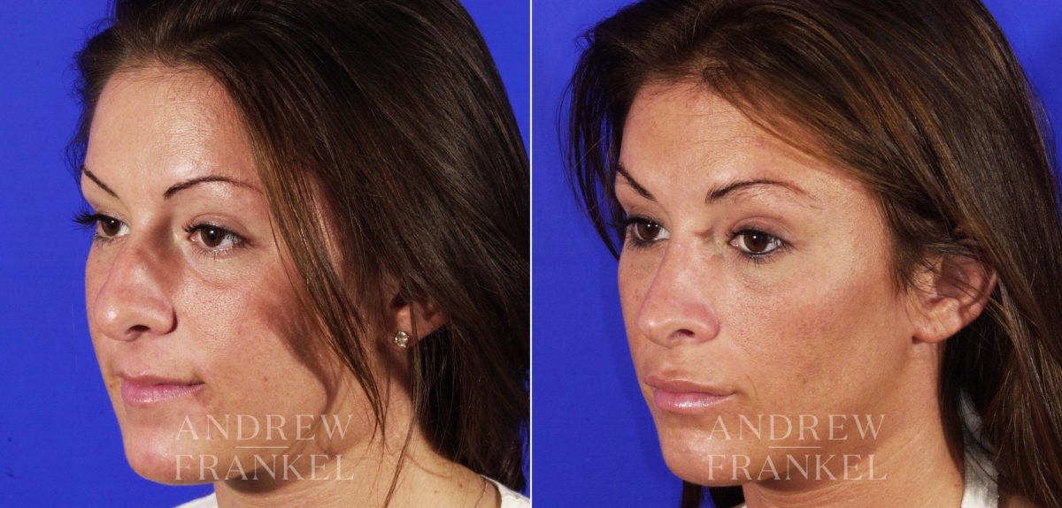 Rhinoplasty before and after photos in Beverly Hills, CA, Patient 6385