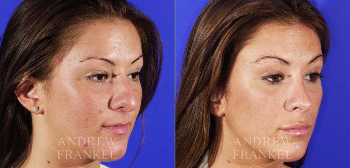 Rhinoplasty before and after photos in Beverly Hills, CA, Patient 6385