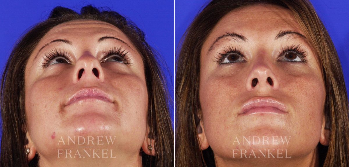 Rhinoplasty before and after photos in Beverly Hills, CA, Patient 6385