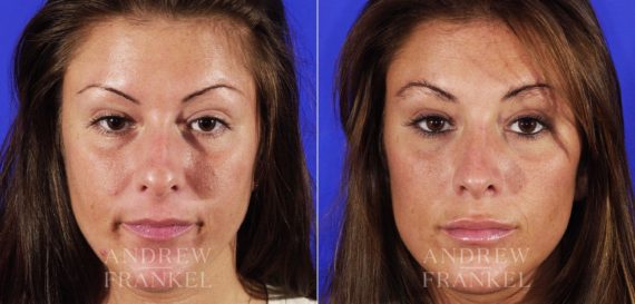 Rhinoplasty before and after photos in Beverly Hills, CA, Patient 6385