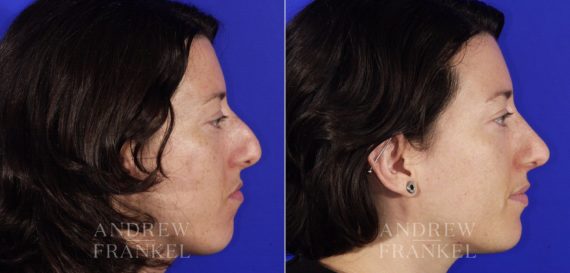 Rhinoplasty before and after photos in Beverly Hills, CA, Patient 6411