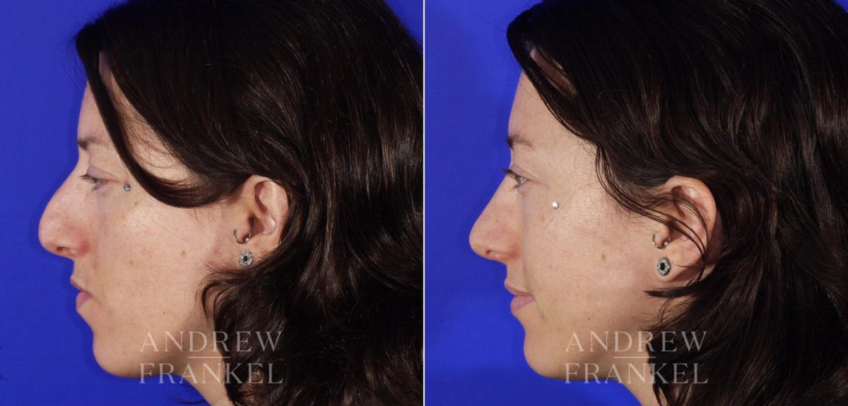 Rhinoplasty before and after photos in Beverly Hills, CA, Patient 6411