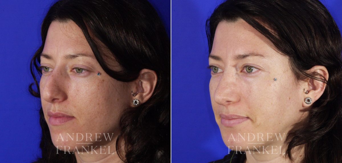 Rhinoplasty before and after photos in Beverly Hills, CA, Patient 6411