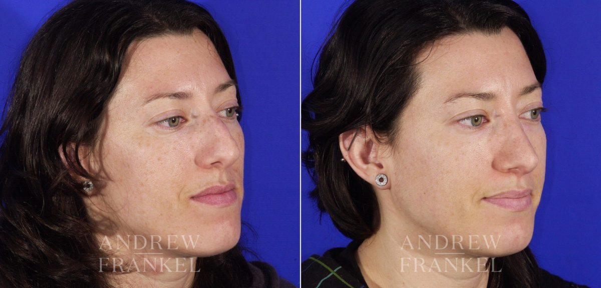 Rhinoplasty before and after photos in Beverly Hills, CA, Patient 6411