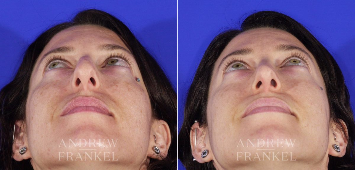 Rhinoplasty before and after photos in Beverly Hills, CA, Patient 6411