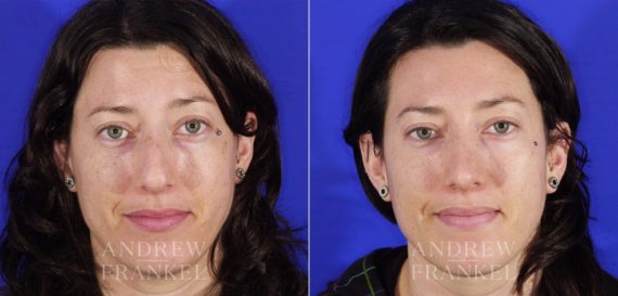 Rhinoplasty before and after photos in Beverly Hills, CA, Patient 6411