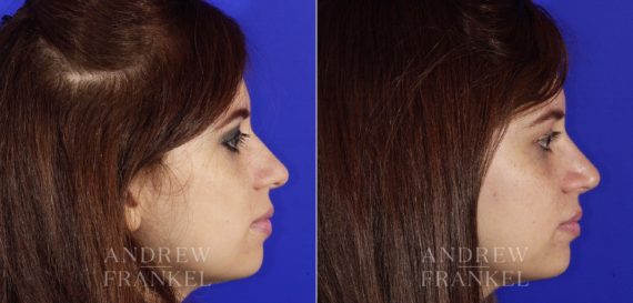 Rhinoplasty before and after photos in Beverly Hills, CA, Patient 6437