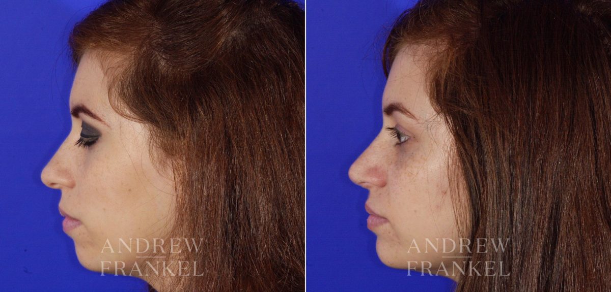 Rhinoplasty before and after photos in Beverly Hills, CA, Patient 6437