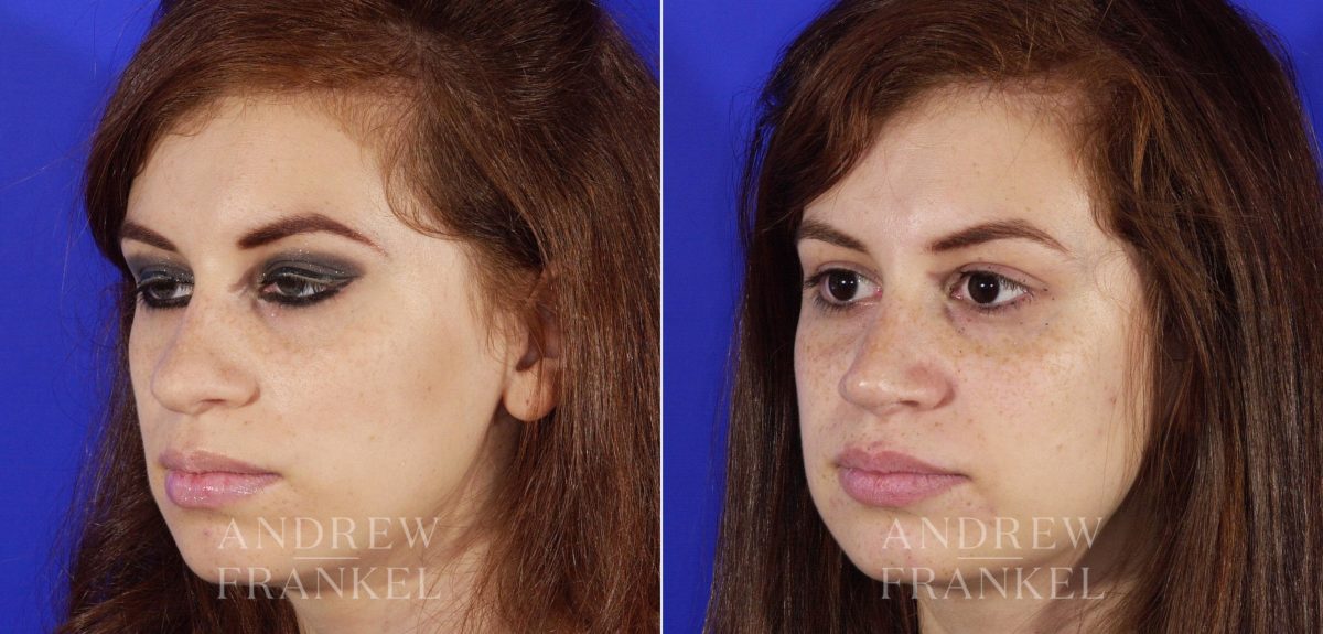 Rhinoplasty before and after photos in Beverly Hills, CA, Patient 6437