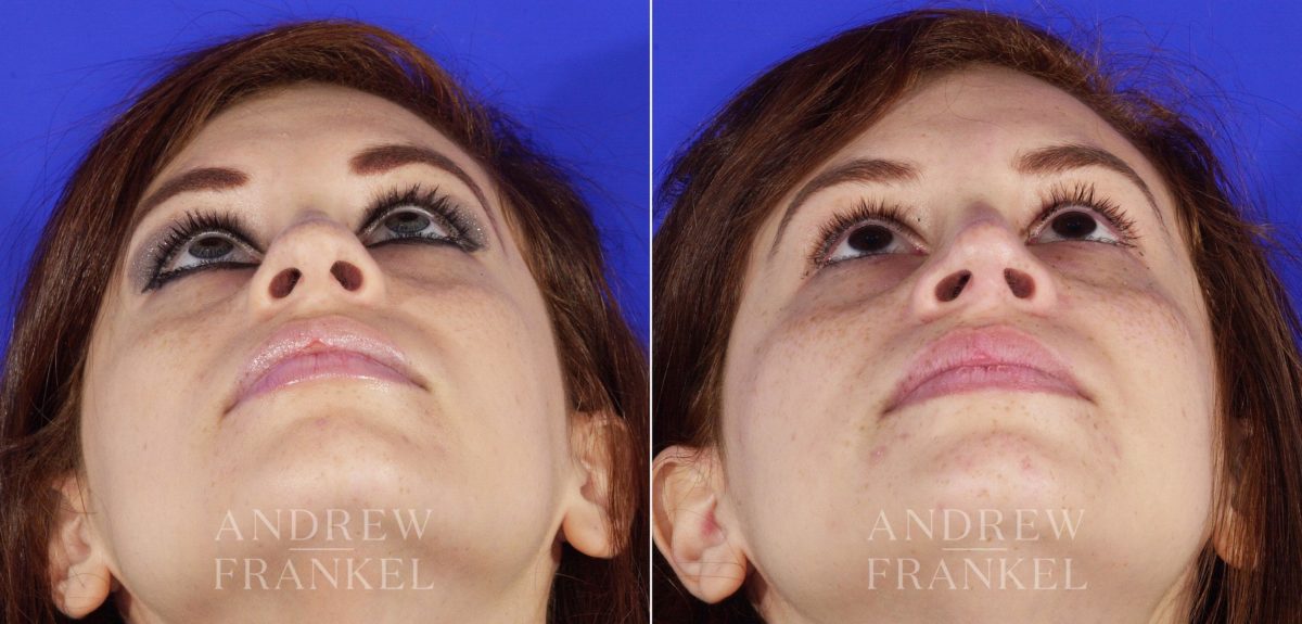 Rhinoplasty before and after photos in Beverly Hills, CA, Patient 6437