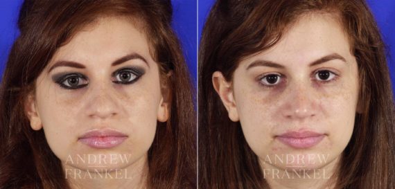 Rhinoplasty before and after photos in Beverly Hills, CA, Patient 6437