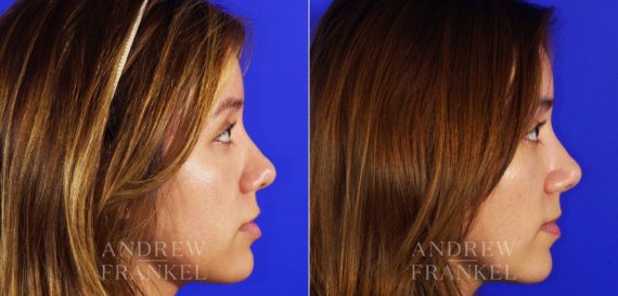 Rhinoplasty before and after photos in Beverly Hills, CA, Patient 6463