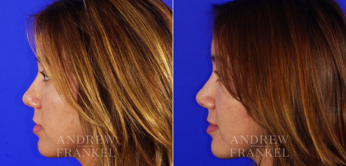 Rhinoplasty before and after photos in Beverly Hills, CA, Patient 6463