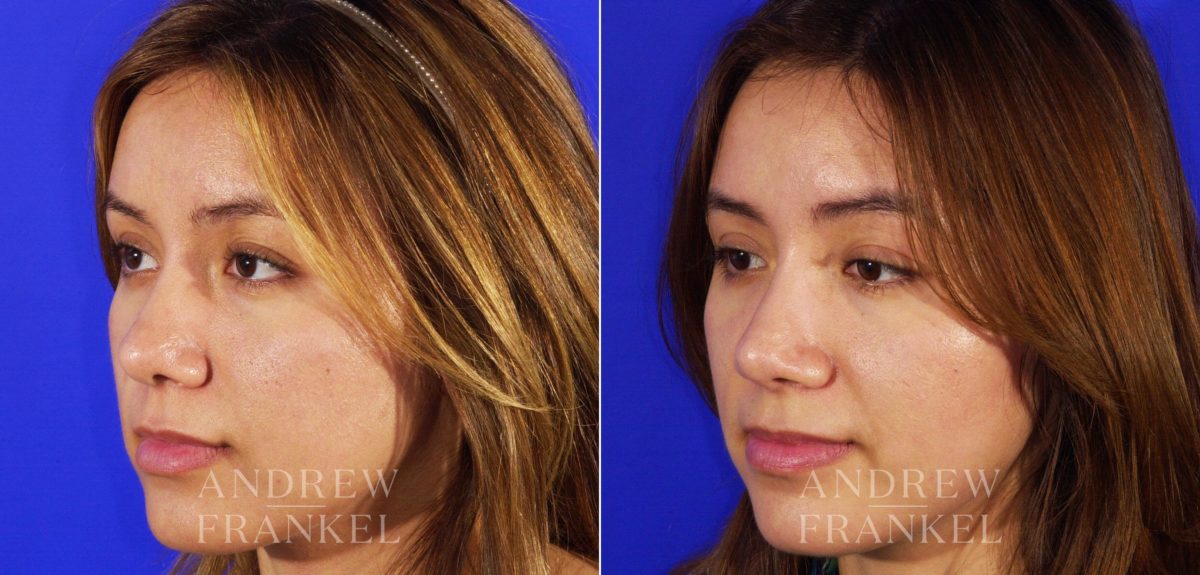 Rhinoplasty before and after photos in Beverly Hills, CA, Patient 6463