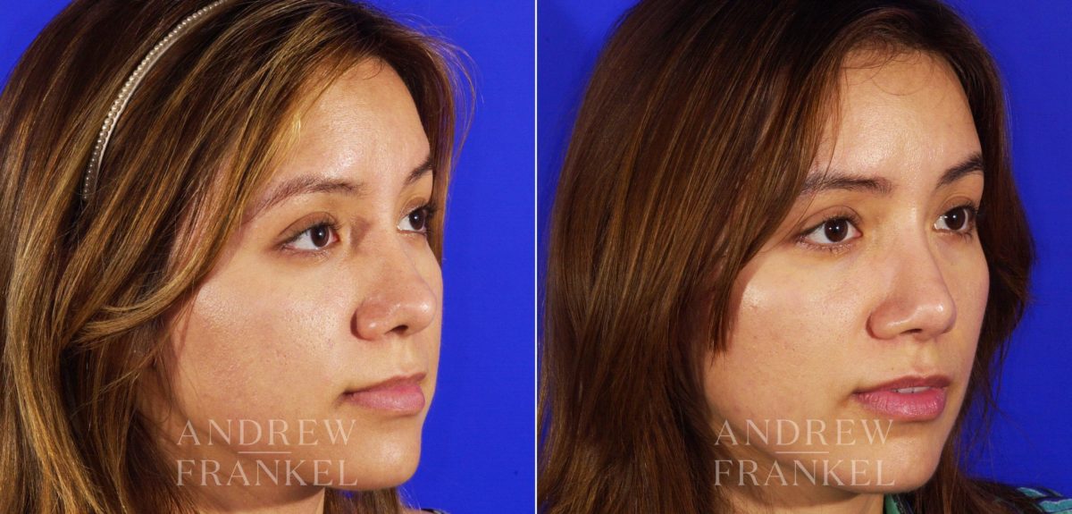 Rhinoplasty before and after photos in Beverly Hills, CA, Patient 6463