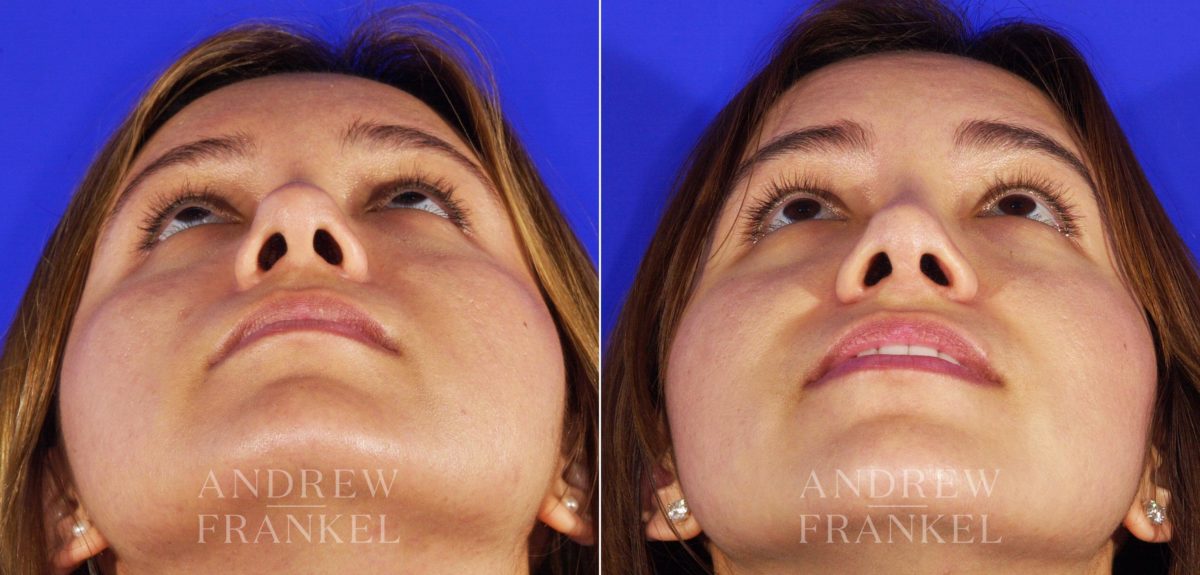 Rhinoplasty before and after photos in Beverly Hills, CA, Patient 6463