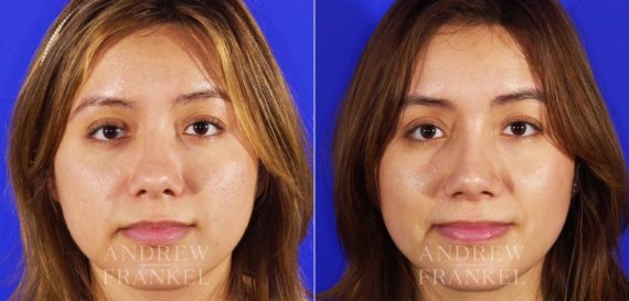 Rhinoplasty before and after photos in Beverly Hills, CA, Patient 6463