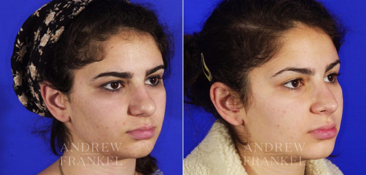 Rhinoplasty before and after photos in Beverly Hills, CA, Patient 6489