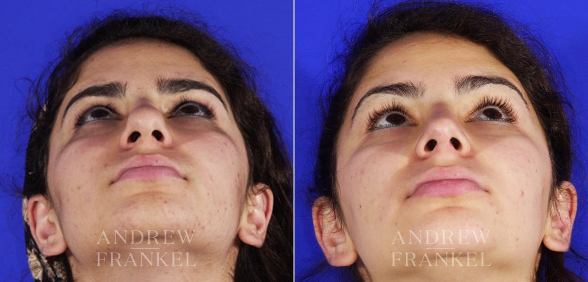 Rhinoplasty before and after photos in Beverly Hills, CA, Patient 6489