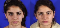 Rhinoplasty before and after photos in Beverly Hills, CA, Patient 6489