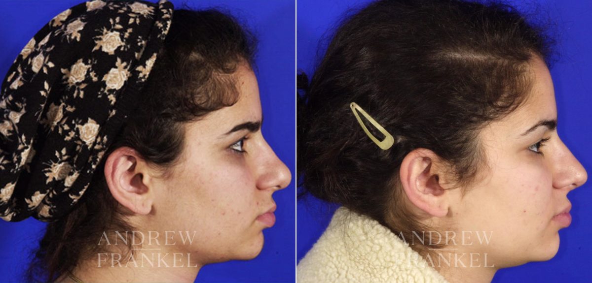 Rhinoplasty before and after photos in Beverly Hills, CA, Patient 6489