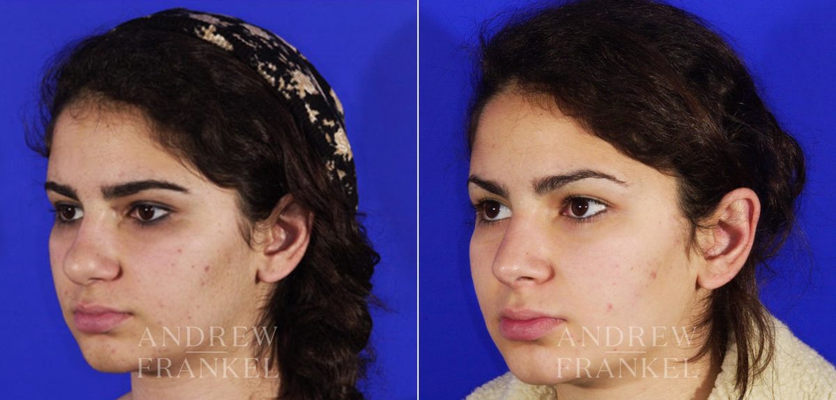 Rhinoplasty before and after photos in Beverly Hills, CA, Patient 6489