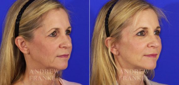 Brow Lift before and after photos in Beverly Hills, CA, Patient 6689