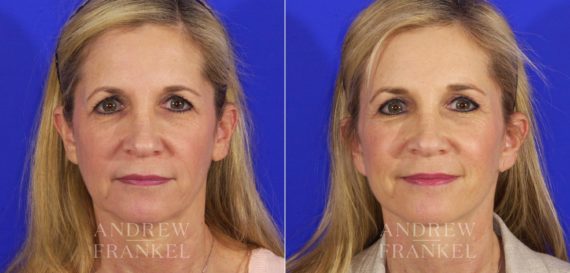 Brow Lift before and after photos in Beverly Hills, CA, Patient 6689